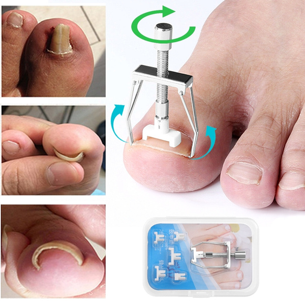 ingrown toenail kit