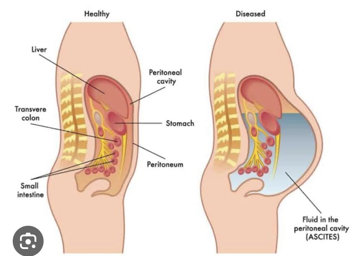 mild to moderate ascites in hindi