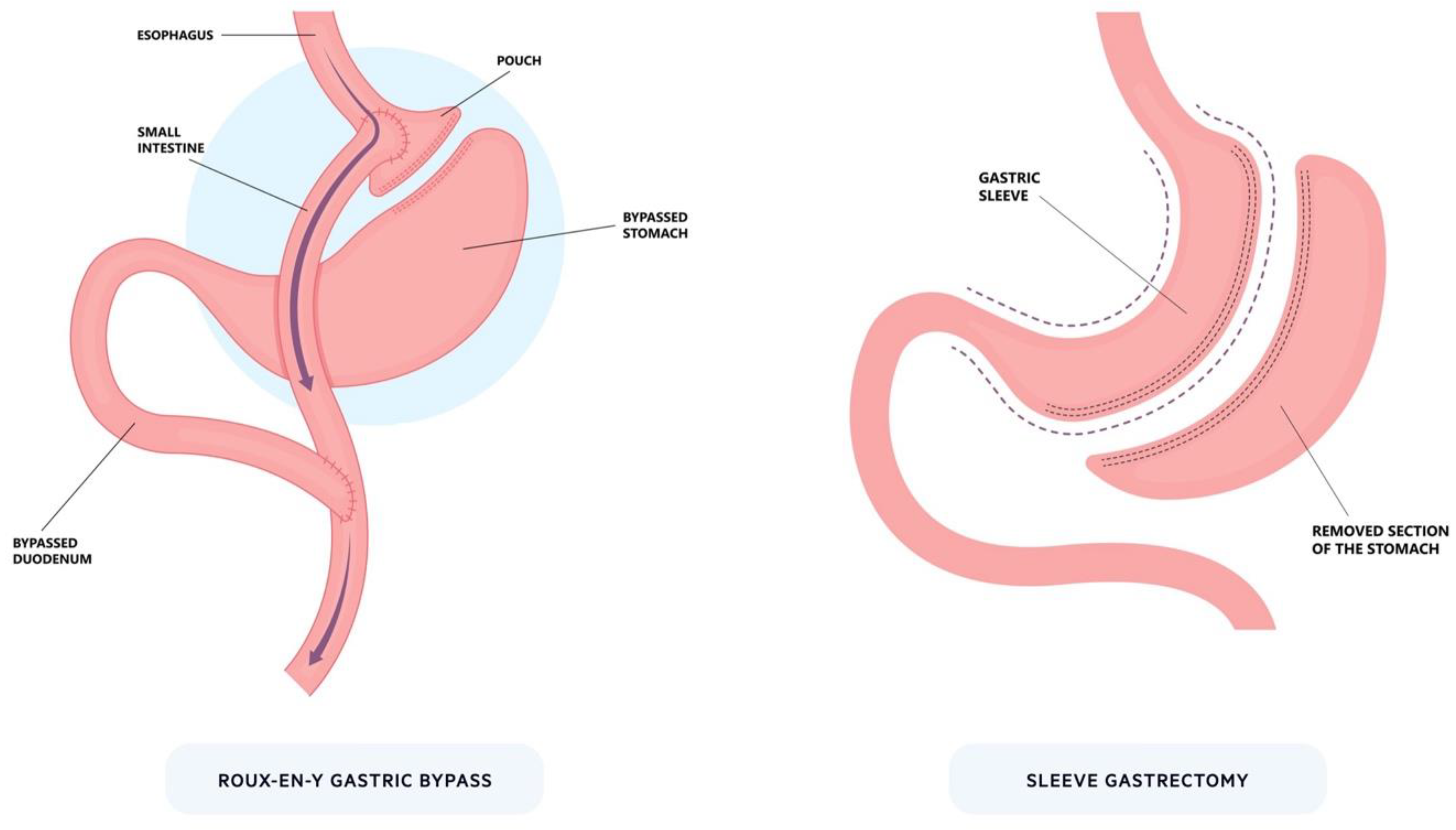 mini gastric bypass forum