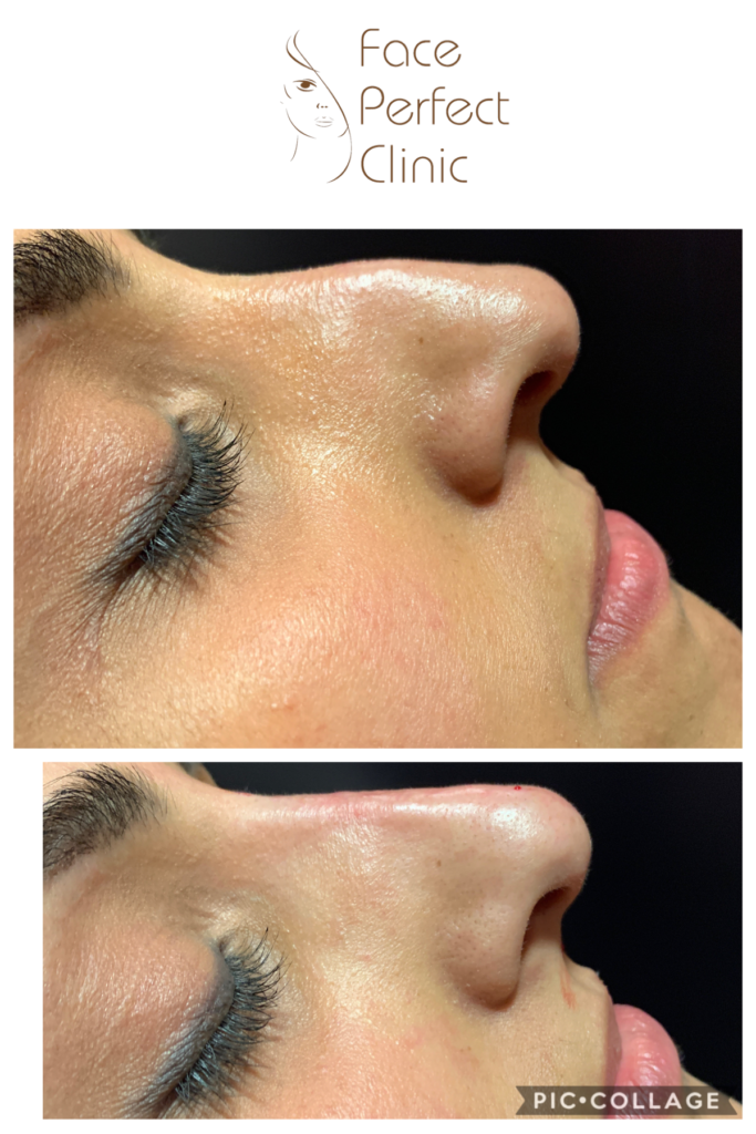 non surgical rhinoplasty leeds