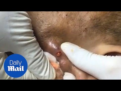 pimple popping videos on youtube