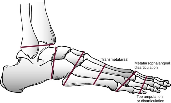 transmetatarsal meaning