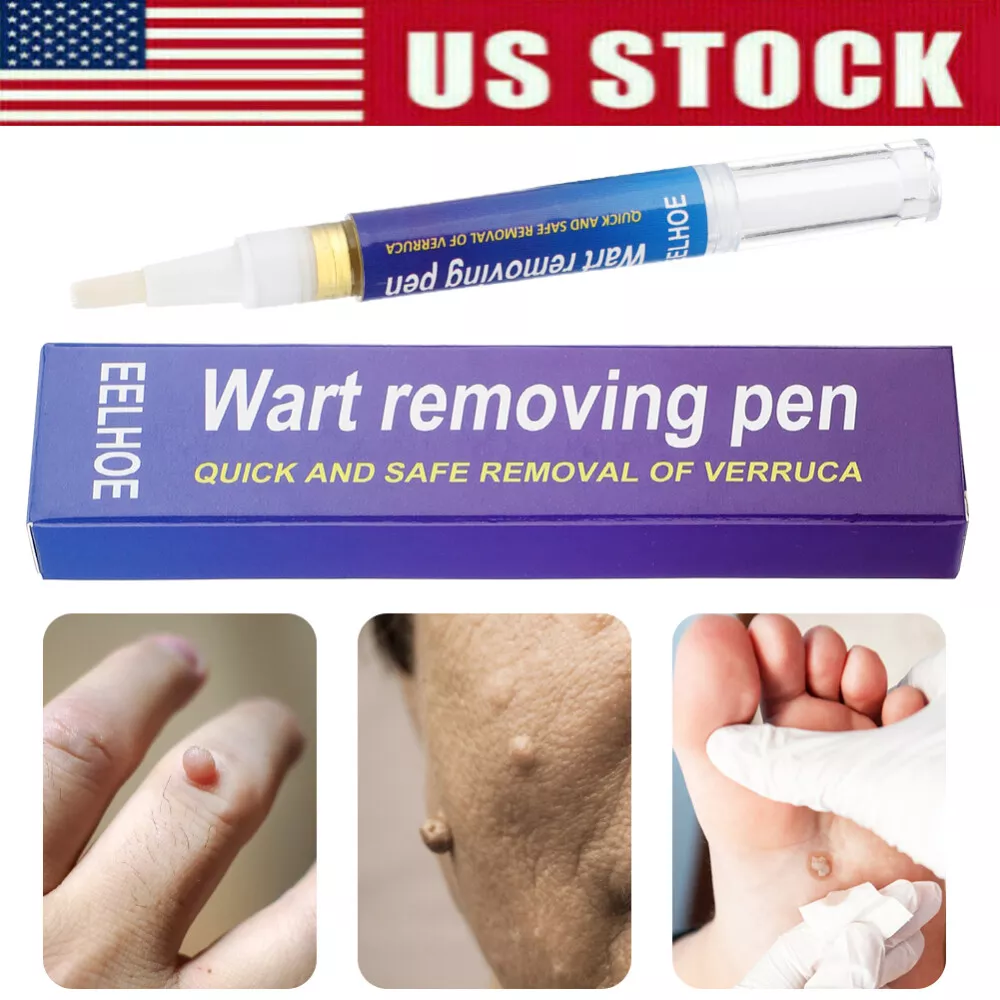 wart removal pen review