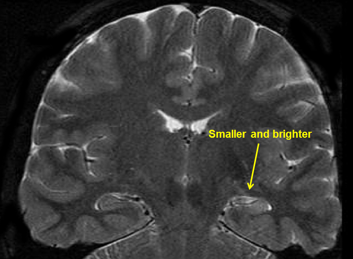 what is temporal lobe epilepsy